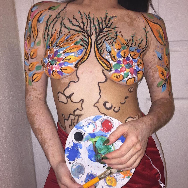 Mulher sofrendo bullying por ter vitiligo transforma seu corpo em arte