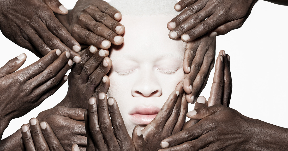 Modelos com albinismo desafiam os padrões de beleza em série fotográfica